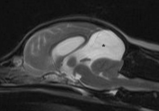 mri arachnoides ekolpoma