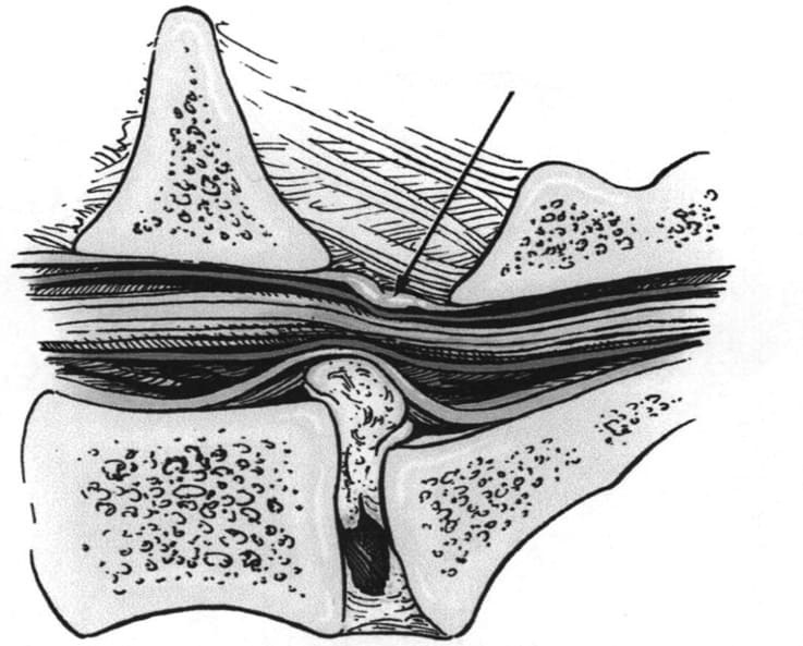 sxediagrama ipoyridas