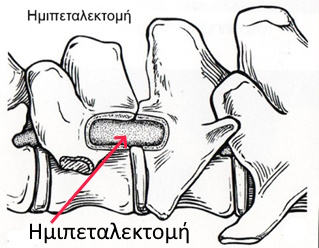 imipetalektomi se diskopauia