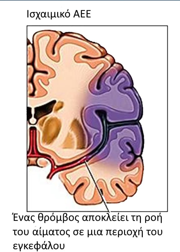 isxemiko aee sxediagrama