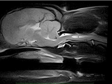 mri dysplasia typou chiari