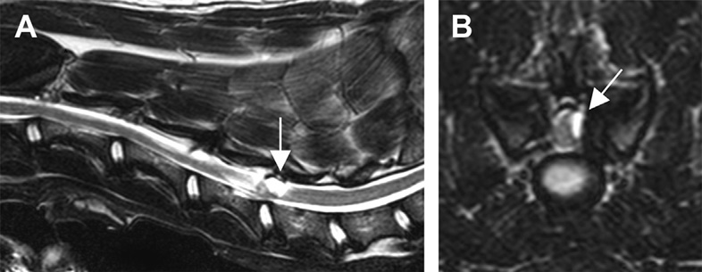 mri kysth epifiakis arurosis