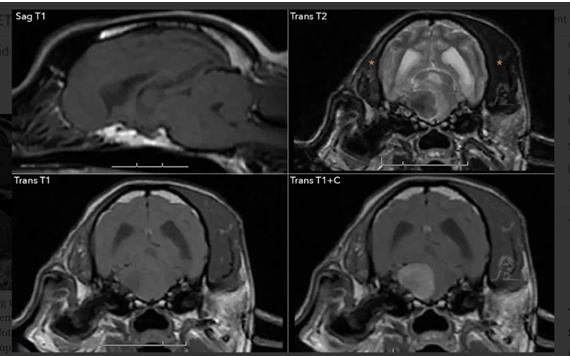 mri se neoplasma tridymoy