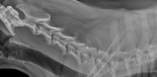 aktinografia ayxeniki spondilosis