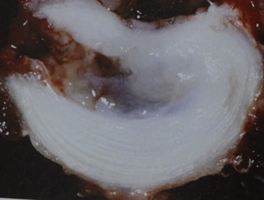 riji mesospondilioy diskoy