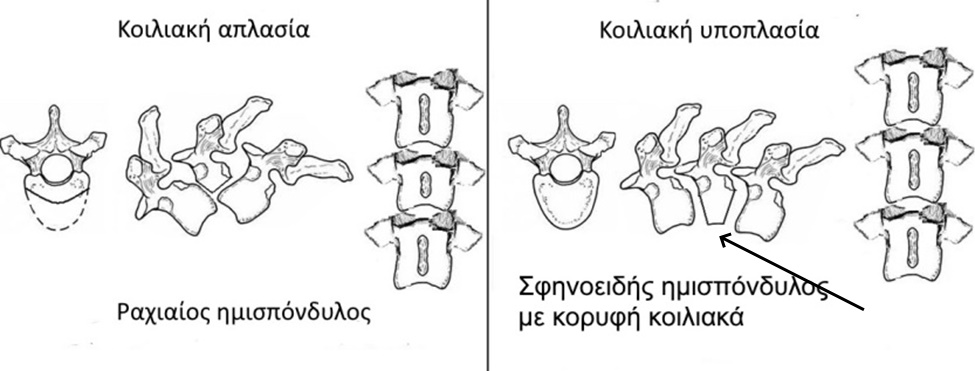 sxediagramma imispondylos