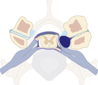 kystha apofysiakhs aruerosis