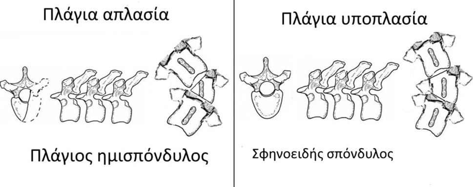 plagios hmispondylos se sxediagrama