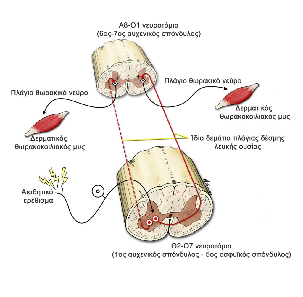 dermatomuiko se sxima