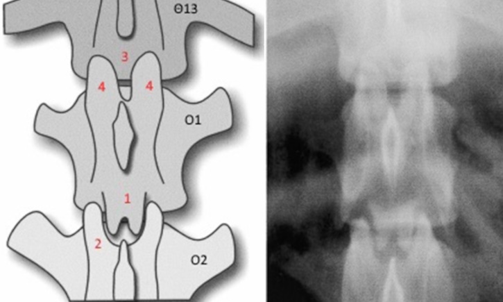 ypoplasia arurikon apofisevn